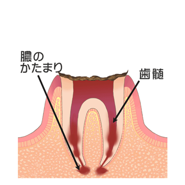 Ｃ４：歯の根まで達した虫歯
